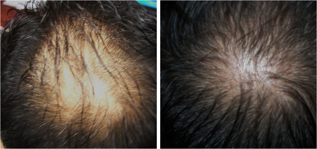 Carboxiterapia para alopecia