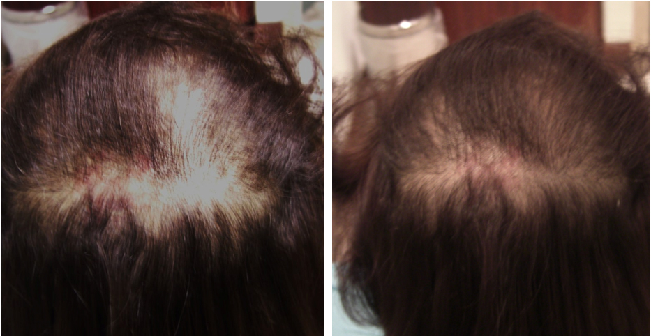 Carboxiterapia para la alopecia