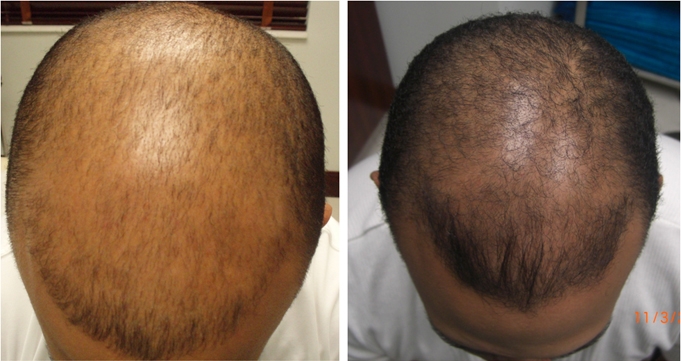 Carboxiterapia para la alopecia