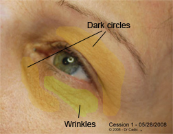 Strategy on wrinkles