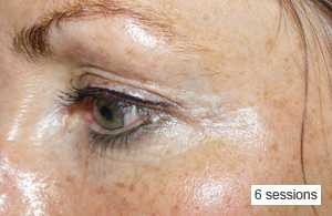 Rejuvenecimiento de ojos con Carboxiterapia - parpados y ojeras