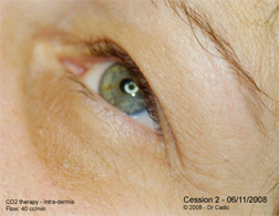  Eye Rejuvenation and carboxytherapy after 6 sessions. Monthly spaced
